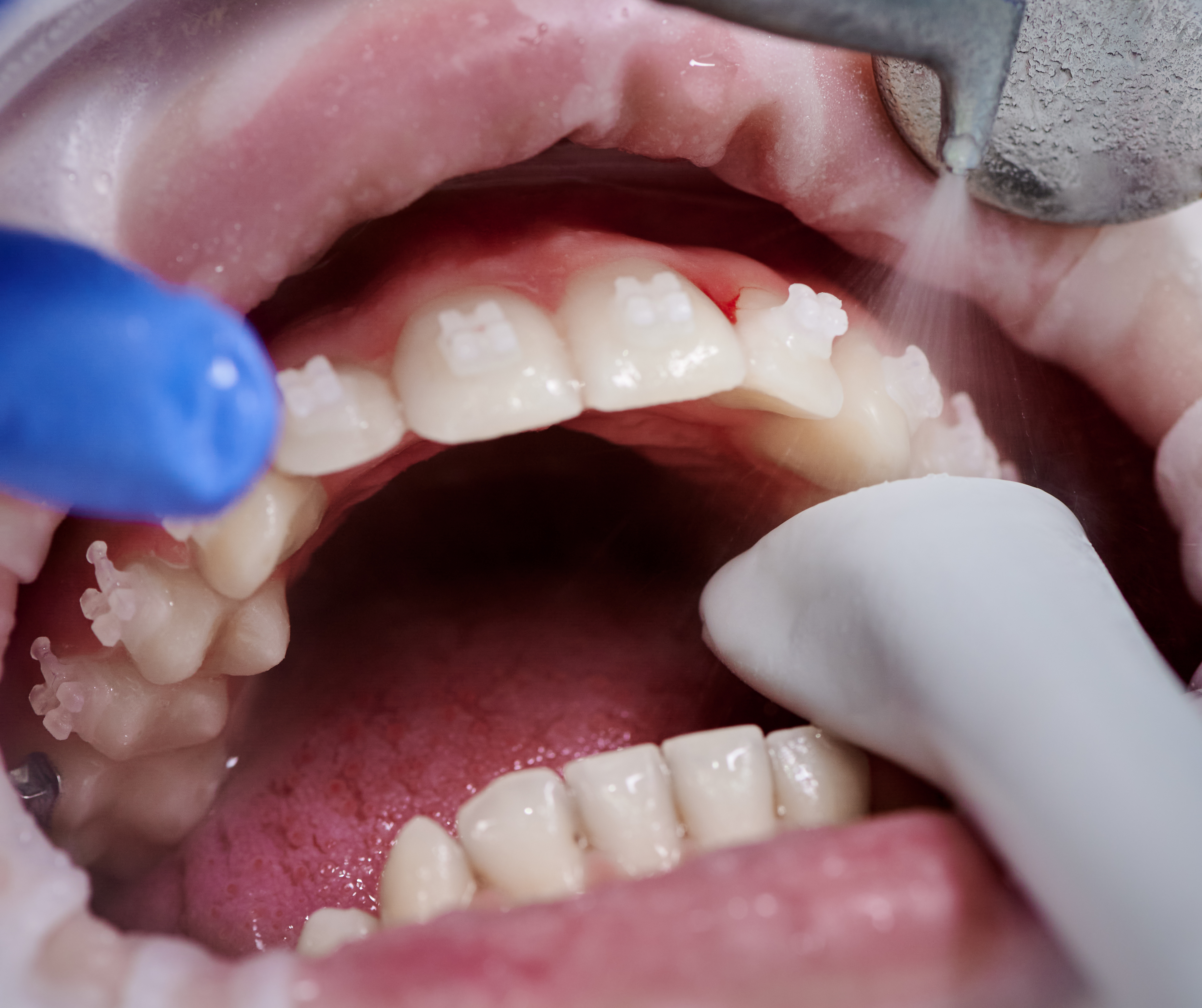 Strategies for Effective Periodontal and Implant Treatment