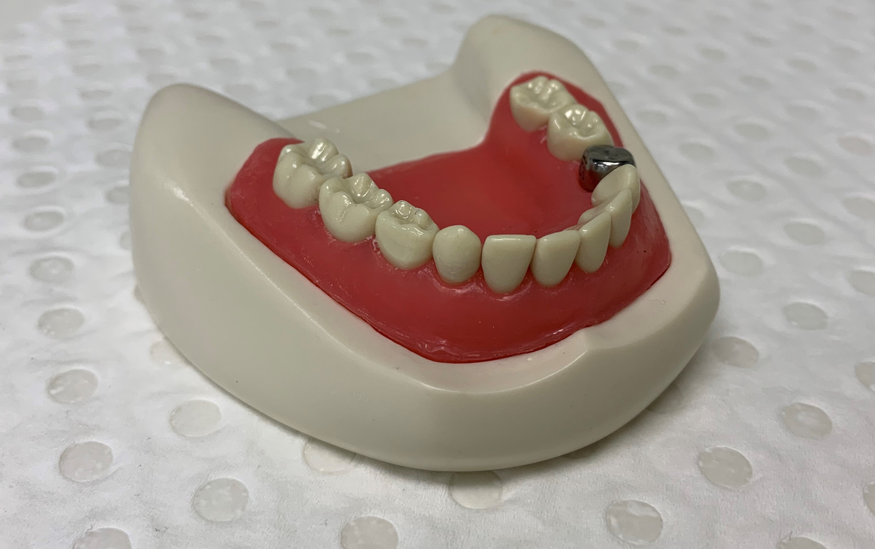 Pre-formed Metal Crowns for paediatric patients